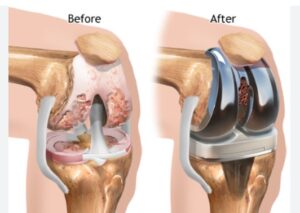 Knee replacement diagram