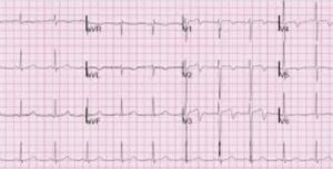 EKG diagram